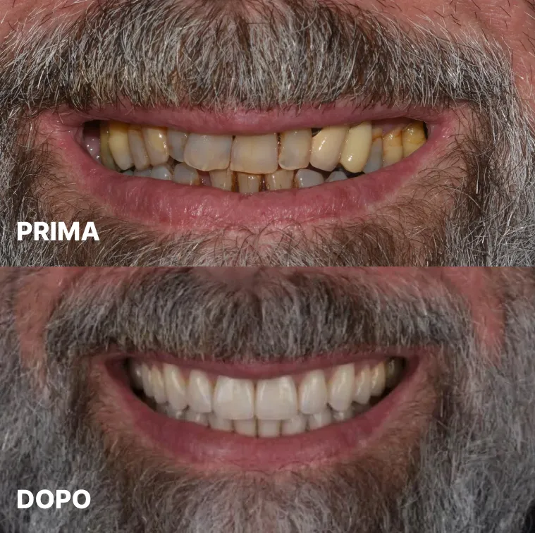 Caso clinico impianti dentali a carico immediato — Studio Dentistico Raco, immagine 1