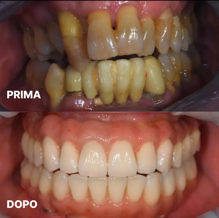 Caso clinico impianti dentali a carico immediato — Studio Dentistico Raco, immagine 4