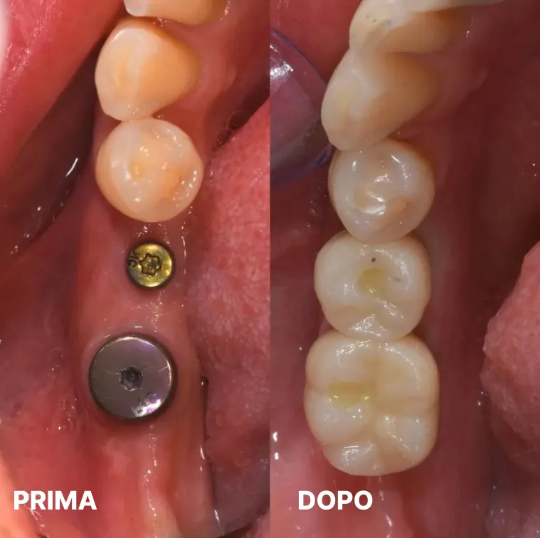 Caso clinico impianti dentali a carico immediato — Studio Dentistico Raco, immagine 5