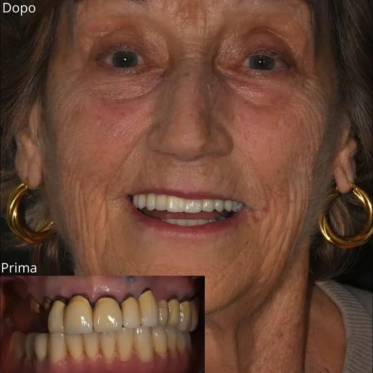 Caso clinico impianti dentali a carico immediato — Studio Dentistico Raco, immagine 3
